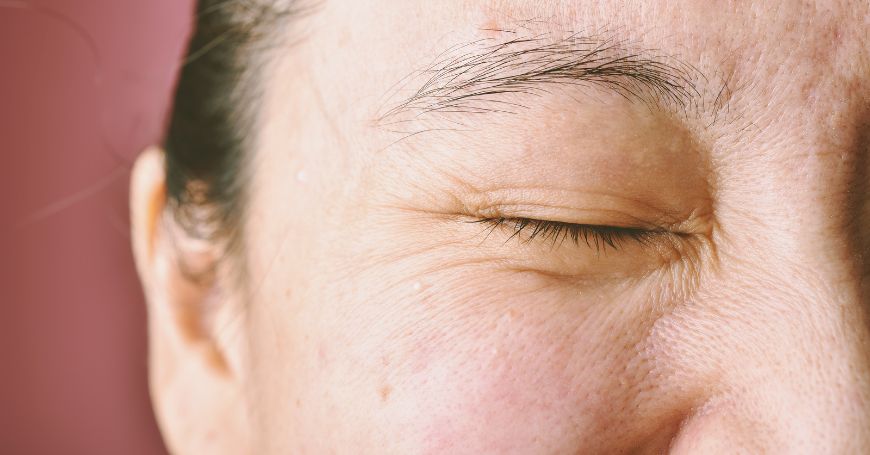 Effetti della Glicazione sulla Pelle di una Donna