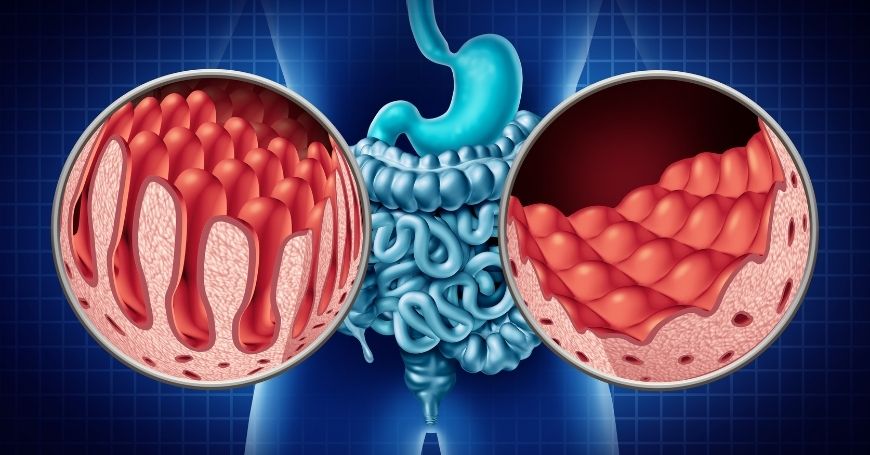 Immagine mostra i benefici degli Omega 3 sull'Intestino