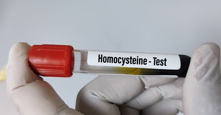L’omocisteinemia: test per misurare i livelli di omocisteina